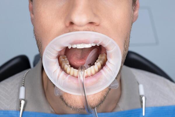 OptraGate Dry Control 